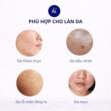 Kem Chăm Sóc Da Mụn IKI BEAUTI 18g - Giảm Mụn, Mờ Thâm, Trắng Sáng Da, Se Khít Lỗ Chân Lông, Giá Ưu Đãi 141.600 VND