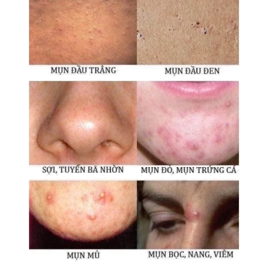 Kem chuyên mụn Ngừa thâm, Tái tạo da Vnice: Hiệu quả nhanh, Giá ưu đãi 125.000