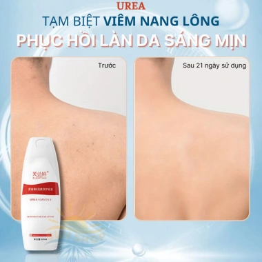 Kem Đào Thải Viêm Nang Lông Urea - Giảm Mụn Lưng Ngực, Dưỡng ẩm, Da Mềm Mịn Sun Sh 2