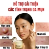 Kem Doctor Care Acnes Elimination 30g - Giảm Mụn Ẩn, Đầu Đen, Thâm, Kiểm Soát Dầu, Da Dầu 2