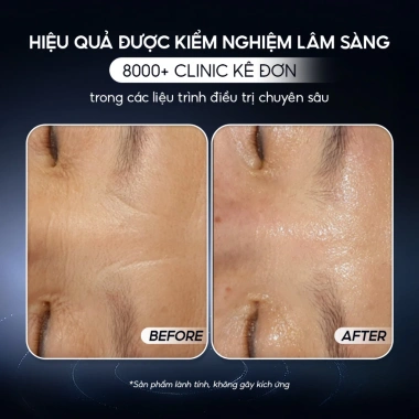 Kem dưỡng ẩm CONAPIDIL CEMENZAL LIGHT 100ml: Tái tạo, lấp đầy sẹo rỗ, giảm giá 23%