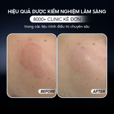 Kem dưỡng ẩm CONAPIDIL CEMENZAL LIGHT 100ml: Tái tạo, lấp đầy sẹo rỗ, giảm giá 23%