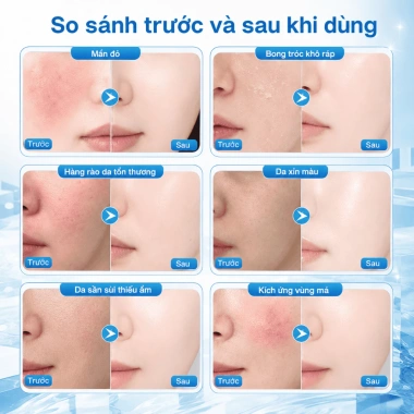 Kem dưỡng B5 YOUNAISI Bisabolol 40ml - Dưỡng ẩm, làm dịu da khô, nhạy cảm, nhờn - Giá ưu đãi 158.000đ 3 Kem dưỡng B5 YOUNAISI Bisabolol 40ml - Dưỡng ẩm, làm dịu da khô, nhạy cảm, nhờn - Giá ưu đãi 158.000đ 3