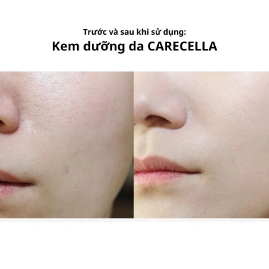 Kem dưỡng da Aqua CARECELLA trắng tự nhiên, dưỡng ẩm, phục hồi, chống lão hóa cho da dầu, mụn, khô - Giảm còn 315.000 VND 2