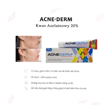 Kem giảm mụn Acne Derm 20% Azelaic Acid 20g - Mờ thâm, trắng sáng da, 160.000đ 3 Kem giảm mụn Acne Derm 20% Azelaic Acid 20g - Mờ thâm, trắng sáng da, 160.000đ 3