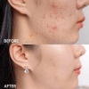 Kem giảm mụn Acne Derm 20% Azelaic Acid 20g - Mờ thâm, trắng sáng da, 160.000đ 6