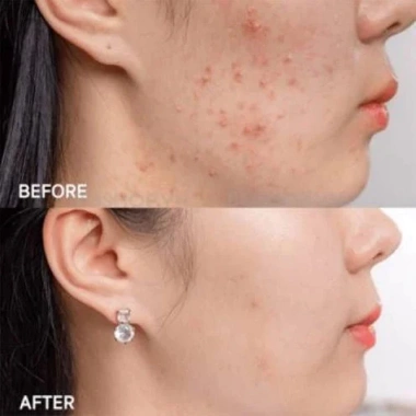 Kem giảm mụn Acne Derm 20% Azelaic Acid 20g - Mờ thâm, trắng sáng da, 160.000đ