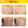 Kem giảm mụn Derma Forte 15g - Giảm mụn nhanh, giá ưu đãi 175.760₫ 3