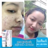 Kem Giảm Thâm Mụn 24h Megaduo Anti-Acne Gel 15g Trắng Sáng, Ức Chế Sắc Tố, Da Đẹp 149.000₫ 4