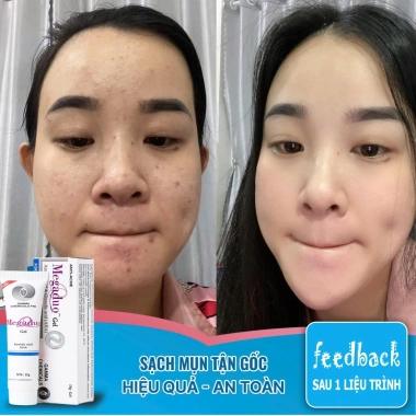 Kem Giảm Thâm Mụn 24h Megaduo Anti-Acne Gel 15g Trắng Sáng, Ức Chế Sắc Tố, Da Đẹp 149.000₫