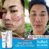 Kem Giảm Thâm Mụn 24h Megaduo Anti-Acne Gel 15g Trắng Sáng, Ức Chế Sắc Tố, Da Đẹp 149.000₫ 6