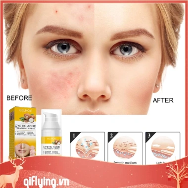 Kem hỗ trợ giảm mụn Cystic 30ml dưỡng ẩm, làm trắng da, giảm sưng, giảm giá 20% chỉ 79.970đ