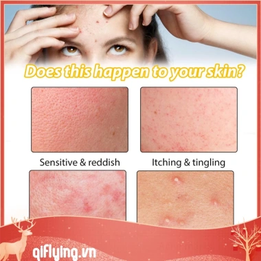 Kem hỗ trợ giảm mụn Cystic 30ml dưỡng ẩm, làm trắng da, giảm sưng, giảm giá 20% chỉ 79.970đ