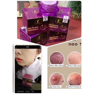 Kem Mụn 2C - Xóa mụn, nám, tàn nhang nhanh, giảm thâm, giá ưu đãi 77.000đ