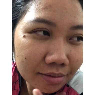 Kem mụn 3 tác dụng Saigon Alpha giảm viêm, mụn, thâm chỉ 3 ngày - chỉ 75.000đ