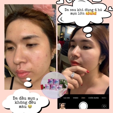 Kem mụn Acne Mỹ Lyn chính hãng - Giảm mụn nhanh, kèm hướng dẫn và túi đựng, 62.900đ 5 Kem mụn Acne Mỹ Lyn chính hãng - Giảm mụn nhanh, kèm hướng dẫn và túi đựng, 62.900đ 5