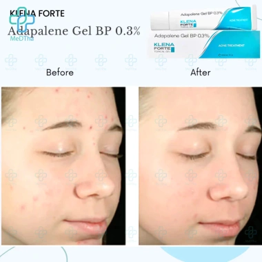 Kem mụn Adapalene Klena và Lumine - Chấm mụn, giảm mụn ẩn, mụn đỏ, mờ thâm, dược mỹ phẩm Ấn Độ, chỉ 155k 7 Kem mụn Adapalene Klena và Lumine - Chấm mụn, giảm mụn ẩn, mụn đỏ, mờ thâm, dược mỹ phẩm Ấn Độ, chỉ 155k 7