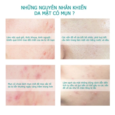 Kem Mụn DR.LeDun Gel Giảm Mụn Trứng Cá, Ngừa Thâm, Mờ Sẹo - Giá Ưu Đãi 189.000₫