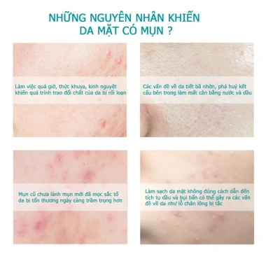 Kem Mụn Dr.Letine Gel Giảm Mụn Trứng Cá - Ngừa Thâm, Mờ Sẹo, Da Dầu, Da Sáng Mịn, Giá ưu đãi 169.000 VND 3 Kem Mụn Dr.Letine Gel Giảm Mụn Trứng Cá - Ngừa Thâm, Mờ Sẹo, Da Dầu, Da Sáng Mịn, Giá ưu đãi 169.000 VND 3