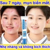 Kem mụn làm sáng da, kiểm soát dầu, loại bỏ mụn ẩn, đầu đen, thâm tuổi dậy thì - 70.000₫