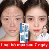 Kem mụn làm sáng da, kiểm soát dầu, loại bỏ mụn ẩn, đầu đen, thâm tuổi dậy thì - 70.000₫ 2