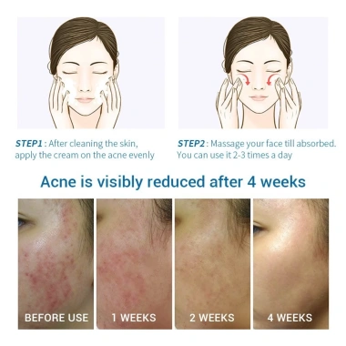 Kem mụn làm sáng da, kiểm soát dầu, loại bỏ mụn ẩn, đầu đen, thâm tuổi dậy thì - 70.000₫ 4