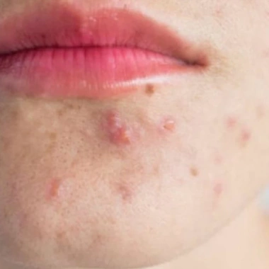 Kem Mụn X5 De‑Rosea Mới - Giảm Sưng Viêm, Dành Cho Tuổi Dậy Thì & Mụn Nội Tiết, Giá 288k
