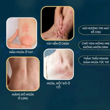 Kem Nấm Nhật - Dứt Điểm Nấm, Ngứa, Hắc Lào, Tổ Đỉa, Cực Hiệu Quả 24k