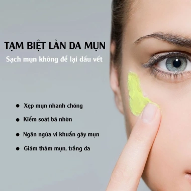 Kem ngừa mụn MyLove trắng da, ngừa vết thâm – Chính hãng Long Phụng Khang 89.000đ