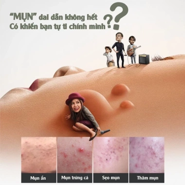 Kem ngừa mụn MyLove trắng da, ngừa vết thâm – Chính hãng Long Phụng Khang 89.000đ 9 Kem ngừa mụn MyLove trắng da, ngừa vết thâm – Chính hãng Long Phụng Khang 89.000đ 9
