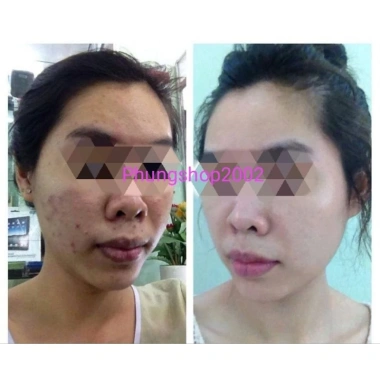 Kem Sâm Nhung Tươi Collagen X10 - Trắng Sáng Da, Giảm Thâm Mụn, Mờ Nám, Da Đều Màu - 189.000đ 5 Kem Sâm Nhung Tươi Collagen X10 - Trắng Sáng Da, Giảm Thâm Mụn, Mờ Nám, Da Đều Màu - 189.000đ 5