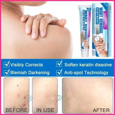 Kem Tẩy Mụn Cóc Tự Nhiên 1 Tuýp - Diệt Papillomas, Giảm Mụn Nhanh, Giá 45.100 3