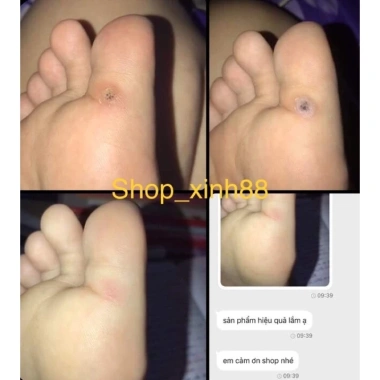 Kem tẩy nốt ruồi, mụn cóc, mụn thịt, mụn cơm, mắt cá – Loại bỏ nhanh 45.000 VNĐ 2