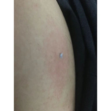 Kem tẩy nốt ruồi, mụn cóc, mụn thịt, mụn cơm, mắt cá – Loại bỏ nhanh 45.000 VNĐ 6