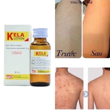Lotion Kella Giảm Viêm Lỗ Chân Lông và Da Thái Lan - Giá chỉ 239.000đ (Giá gốc 296.360đ)