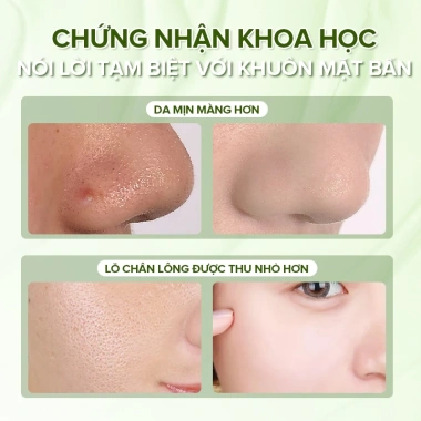 Mặt nạ Ftso làm sạch sâu lỗ chân lông, loại bỏ đầu đen, dưỡng ẩm - Giá chỉ 99.000₫
