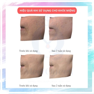 Mặt Nạ Nâng Cơ Xóa Nhăn CareCella – Cấp Ẩm, Mờ Thâm, Dưỡng Da, Da Mềm Mịn 8