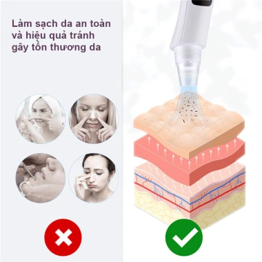 Máy hút mụn đầu đen GOKE 5 đầu, làm sạch lỗ chân lông, bảo hành 1 năm - 176.000₫ 5