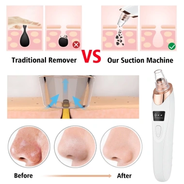 Máy hút mụn đầu đen làm sạch sâu, thu nhỏ lỗ chân lông - Giá chỉ 418.000 VNĐ 3 Máy hút mụn đầu đen làm sạch sâu, thu nhỏ lỗ chân lông - Giá chỉ 418.000 VNĐ 3