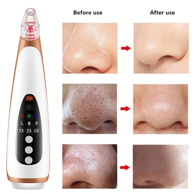 Máy hút mụn GOKE Pro mạnh, pin dung lượng cao, sạch, bảo hành 1 năm - 176.000₫ 2