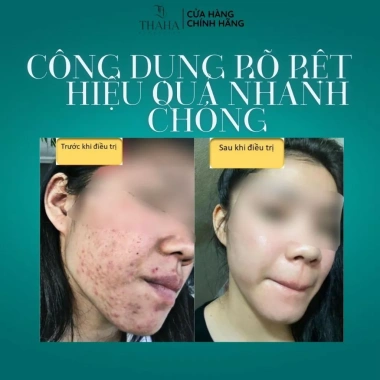 MH Beauty Spa Thần dược MH 5ml Serum giảm mụn, dưỡng phục hồi da, làm dịu da 112.500₫