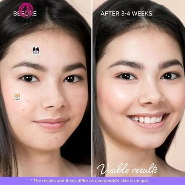 Miếng Dán Mụn Hydrocolloid Hình Mèo Springevenstar 100 miếng - Dễ Thương, Giá 75.680đ