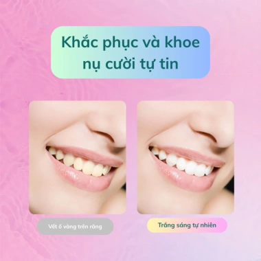 Miếng Dán Trắng Răng Ivismile: Làm Sạch Ố Vàng, Răng Trắng Tự Nhiên, Hộp 7 Cặp 14 Miếng Giá 89.000đ 4 Miếng Dán Trắng Răng Ivismile: Làm Sạch Ố Vàng, Răng Trắng Tự Nhiên, Hộp 7 Cặp 14 Miếng Giá 89.000đ 4