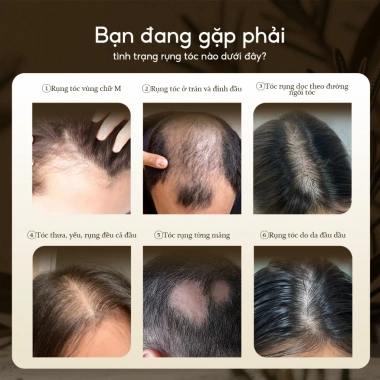 Mua 1 được 5 Xịt mọc tóc Lab on Hair 160ml - Giá ưu đãi 693k, hỗ trợ tóc hư tổn nhanh 3