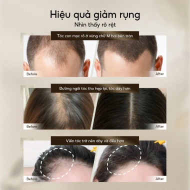 Mua 1 được 5 Xịt mọc tóc Lab on Hair 160ml - Giá ưu đãi 693k, hỗ trợ tóc hư tổn nhanh 5