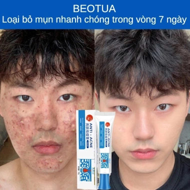 Mua 2 tặng 1 Kem chấm mụn cấp tốc 25g, loại bỏ mụn đầu đen, mụn tuổi dậy thì, da dầu, giá chỉ 60.000