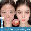 Mua 2 tặng 1 Kem chấm mụn cấp tốc 25g, loại bỏ mụn đầu đen, mụn tuổi dậy thì, da dầu, giá chỉ 60.000 2
