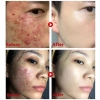 Mua 2 tặng 1 Kem chấm mụn cấp tốc 25g, loại bỏ mụn đầu đen, mụn tuổi dậy thì, da dầu, giá chỉ 60.000 3