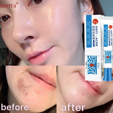 Mua 2 tặng 1 Kem chấm mụn cấp tốc 25g, loại bỏ mụn đầu đen, mụn tuổi dậy thì, da dầu, giá chỉ 60.000