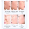 Mua 2 tặng 1 Kem chấm mụn cấp tốc 25g, loại bỏ mụn đầu đen, mụn tuổi dậy thì, da dầu, giá chỉ 60.000 6